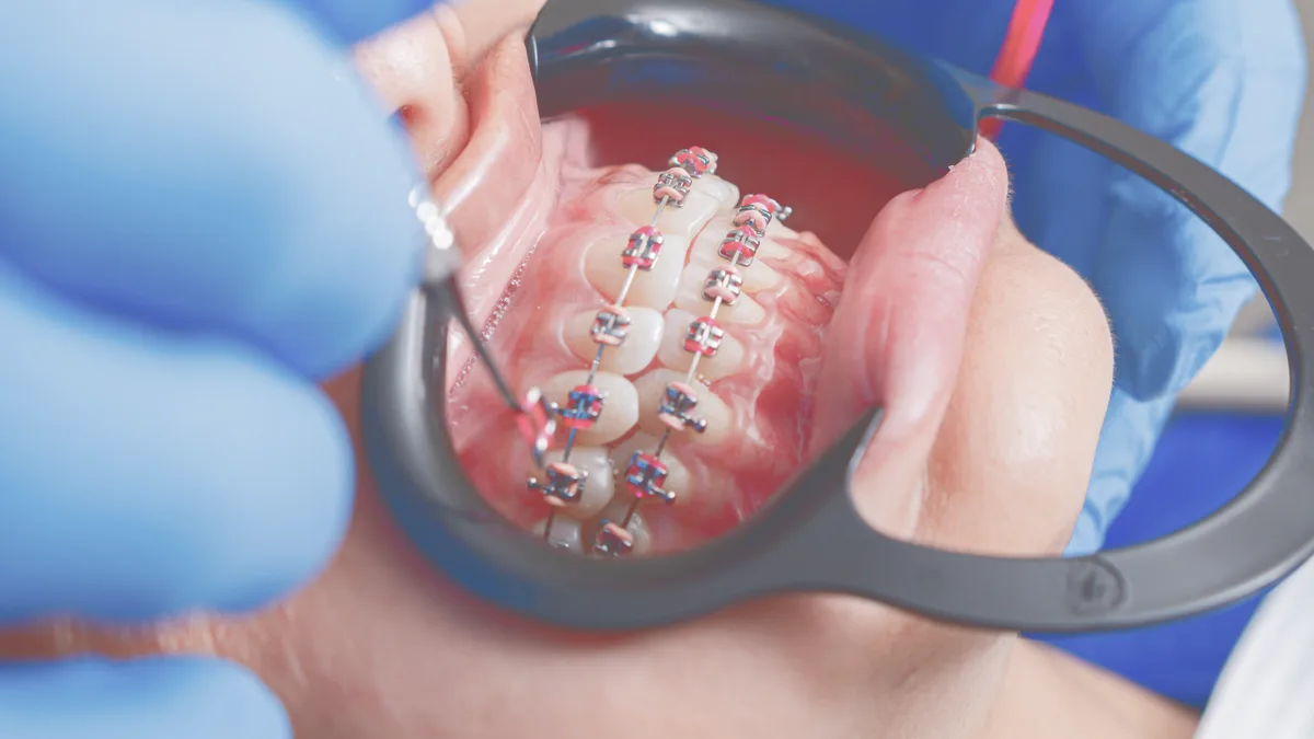Close-up of fixed orthodontic brackets being adjusted with an instrument.